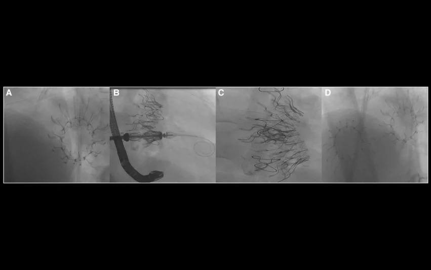 Cardiologists in Germany have successfully performed transcatheter mitral valve replacement (TMVR) and transcatheter tricuspid valve replacement (TTVR) on a single patient with the same prosthesis, sharing their experience in European Heart Journal—Case Reports.[1] The two procedures occurred within 18 months of one another. Cardiovalve.