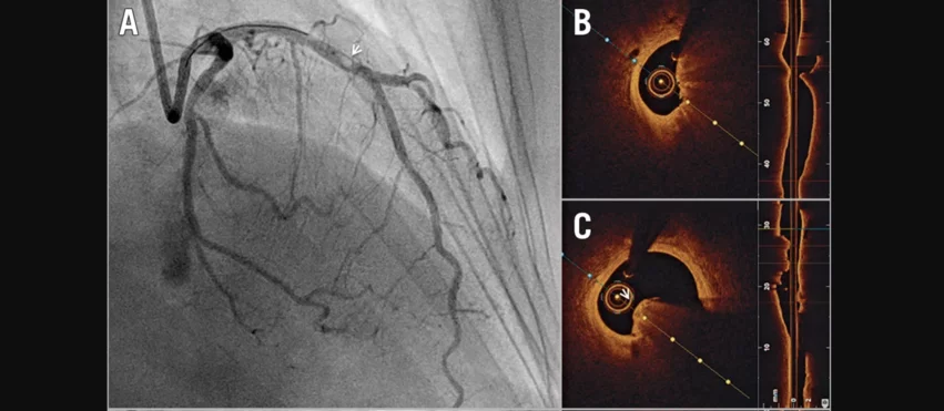 OCT-guided PCI, or optical coherence tomography-guided percutaneous coronary intervention. Optical coherence tomography-guided percutaneous coronary intervention on a calcific protruding nodule. A) Angiography shows a mid-left anterior descending (LAD) nodular obstruction (arrowhead). B) Optical coherence tomography (OCT) imaging reveals a small minimal lumen area and (C) confirms the aetiology of the obstruction to be a calcific protruding nodule (arrowhead). Images courtesy of EuroIntervention 