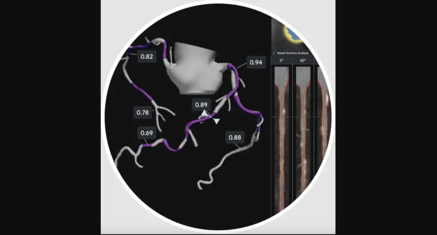 HeartFlow Plaque Analysis Example