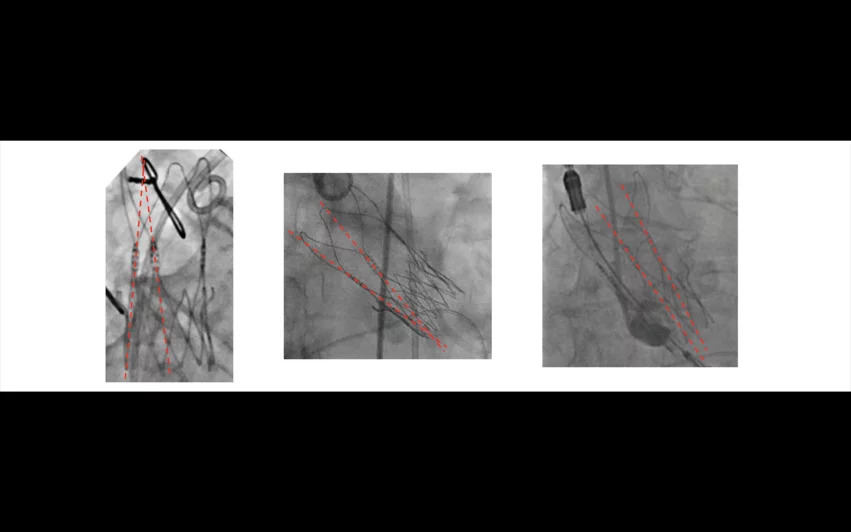 One of the primary reasons the Boston Scientific offering fell short was the fact that approximately 20% of valves were not fully expanded; researchers did not notice this trend until a team of engineers blinded to the study’s results reviewed post-TAVR angiographic imaging of each patient. 
