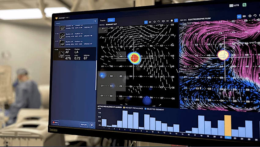 The Cortex OptiMap EP mapping system aims to improve atrial fibrillation ablation outcomes using its Electrographic Flow Mapping technique. This offers a new way to visualize the arrhythmia source and electrical conduction.