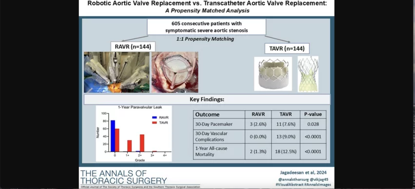 Using advanced robotics to guide surgical aortic valve replacement (SAVR) procedures may be a safe and effective alternative to transcatheter aortic valve replacement (TAVR) in low- and intermediate-risk patients with severe aortic stenosis (AS), according to a new analysis published in The Annals of Thoracic Surgery.