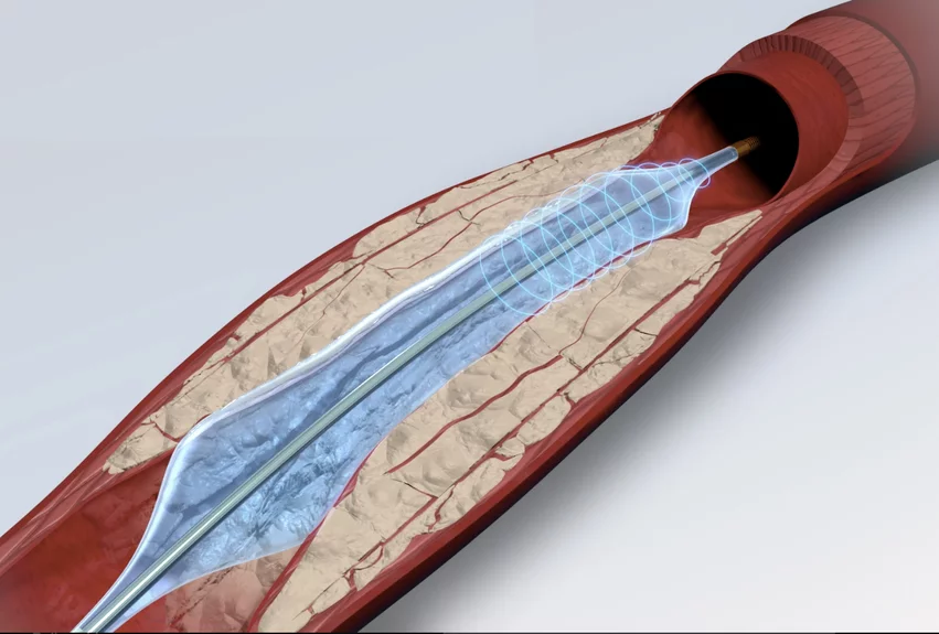 The AVS Pulse IVL balloon sending lithotripsy pulses through the catheter into the balloon, which eliminates catheter-mounted emitters. The company said this helps make a much lower-profile device to better access tight, calcified lesions.