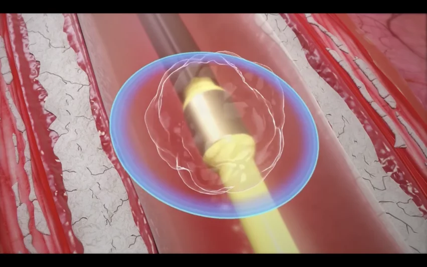 The use of intravascular lithotripsy (IVL) during percutaneous coronary intervention (PCI) is still safe and effective when patients present with calcified nodules (CNs), according to new long-term data published in EuroIntervention.[1] Researchers compared outcomes from patients with and without CNs, highlighting key similarities in stent expansion and luminal gain.