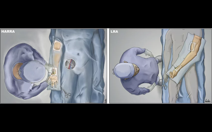 Using a left radial artery (LRA) vs. hyper-adducted right radial artery (HARRA) approach in the cath lab