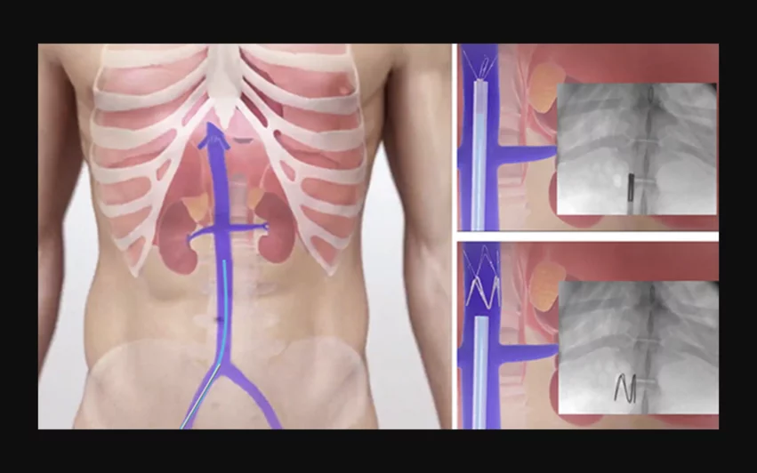 Illustration showing how ti implant the FIRE1 Norm IVC heart failure fluid overload detection monitor.
