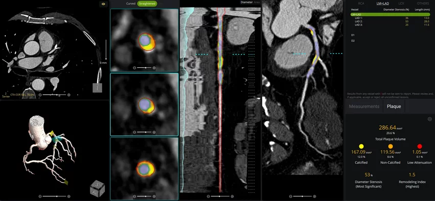cvi42 | Plaque Circle Cardiovascular Imaging