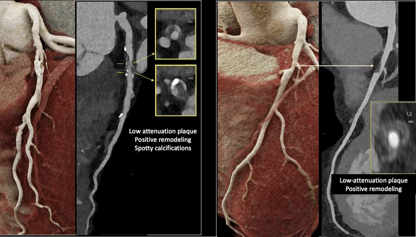 Two examples of photon-counting CT highlighting soft coronary plaques with high-risk features. CCTA can now show detailed soft plaque anatomy that can improve patient risk assessments for heart attacks. Photo courtesy of Ron Blankstein