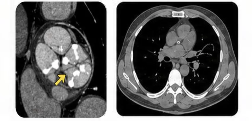 Examples of non-contrast, non-gated CT scans performed for non-cardiac reasons that clearly show incidental aortic stenosis. This type of opportunistic CT AI imaging could change the way patients are screened for AS to enable earlier interventions. Images from the SCCT 2026 presentation by Ofir Koren, MD, Cedars-Sinai.