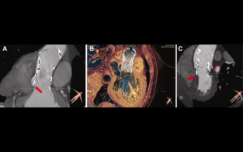 The NCPI-plus TAVR technique