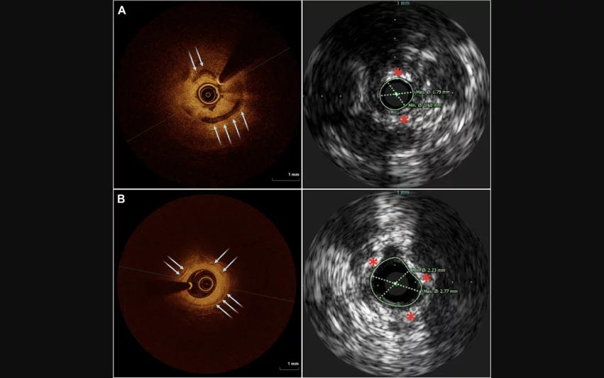 Examples of OCT (left) and IVUS (right) images of two different subjects with calcium. Blue arrows denote calcium noted on OCT, red asterisks mark calcium on IVUS