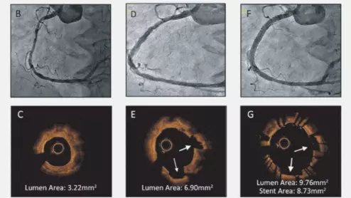 A comparison of before and after angiography images (top) and optical coherence imaging (OCT - below) showing the impact of intravascular lithotripsy (IVL) in coronary arteries in the DISRUPT CAD III trial. 