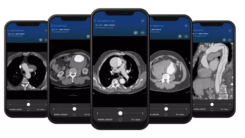 Examples of CT imaging showing aortic dissections on an acute AAA response team app that was recently cleared by the FDA from Viz.AI. 