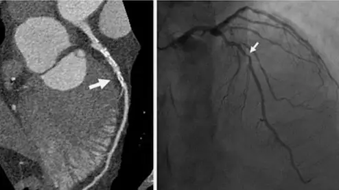 An example of a noninvasive coronary CT scan on the left and an invasive angiogram of the same patient on the right from a recent RSNA study. The CT shows more information on the calcified nature of the plaque and shows more anatomical information beyond what the angiogram provides.