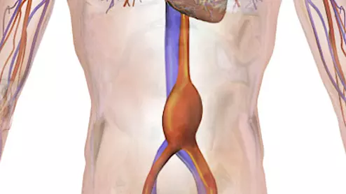 Abdominal aortic aneurysm (AAA)