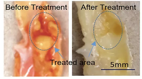 Example of ultrasound-assisted laser arterial plaque removal, which might be developed into a new type of less traumatic atherectomy system.Image courtesy of Rohit Singh.