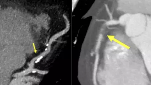 Examples of new plaque reporting in the CAD-RADS 2.0 document. Left, an example from CAD-RADS 2 / P2 plaque burden with mild coronary stenosis (25-49%). Right, example of a CAD-RADS 5/ P3, with a focal, non-calcified occlusion of the proximal RCA (arrow) and severe amount of plaque (P3). #CADRADS #YesCCT #CTA #CCTA 