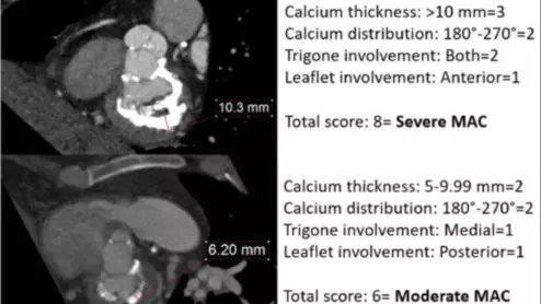 Mitral annular calcium (MAC) does not appear to have a negative effect on long-term transcatheter aortic valve replacement (TAVR) outcomes, according to new research published in the American Journal of Cardiology.
