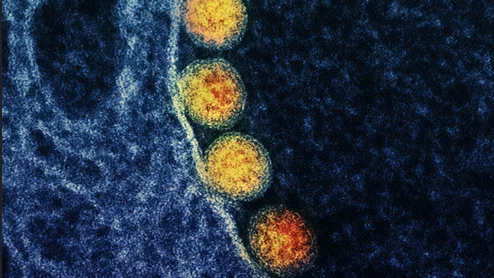 COVID from a patient's nasal passage. Transmission electron micrograph of SARS-CoV-2 virus particles (gold) within endosomes of a heavily infected nasal olfactory epithelial cell. Image captured at the NIAID Integrated Research Facility (IRF) in Fort Detrick, Maryland. Image courtesy of NIAID. What does COVID look like?