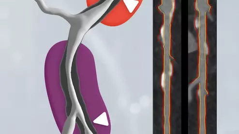 Left, HeartFlow's RoadMap analysis enables cardiac CT readers to identify stenoses in the major coronary arteries. The AI provides visualization and quantification of the location and severity of anatomic narrowings. Right image, HeartFlow's Plaque Analysis AI algorithm automates assessment of coronary plaque characteristics and volume on CCTA exams to greatly reduce the time it takes to manually assess and quantify these features. 