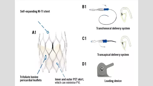 A team in China treated 10 patients—split evenly between men and women—with the SinoCrown TAVR valve developed by Lepu Medical Technology Company. The average patient age was 77.5 years old.