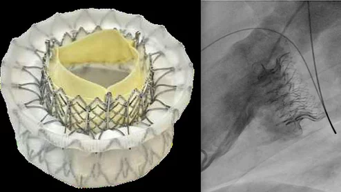 The Cephea transcatheter mitral valve in development has been acquired by Medtronic.