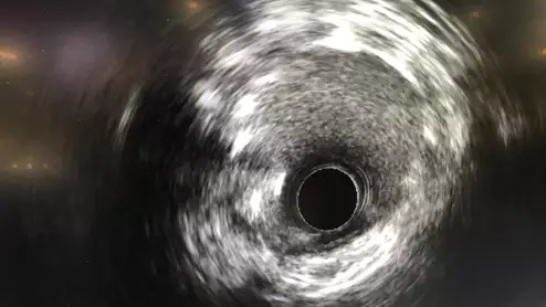 Example of intravascular ultrasound (IVUS) shown as part of the multimodality imaging capability on the Fujifilm CVIS.