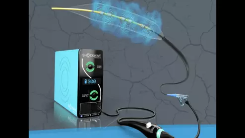 Shockwave L6 Peripheral IVL Catheter Shockwave Medical 
