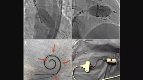 The Wattson temporary pacing guidewire from Teleflex