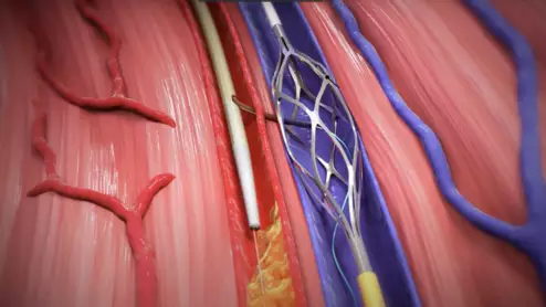 FDA approves LimFlow System for Transcatheter Arterialization of Deep Veins for CLTI