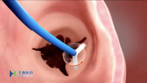K-Clip Transvascular Tricuspid Repair System from Huihe Healthcare