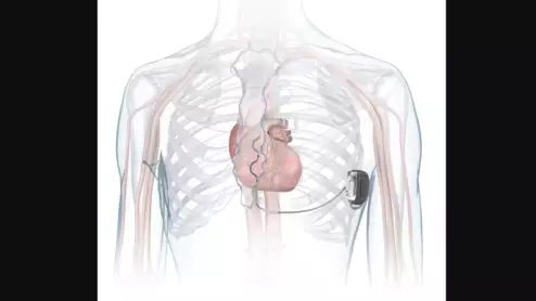 Medtronic extravascular ICD Aurora EV-ICD MRI SureScan