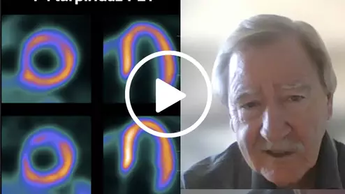 Timothy Bateman, MD, co-director, cardiovascular radiologic imaging program, Saint Luke's Mid America Heart Institute, professor of medicine at the University of Missouri-Kansas City School of Medicine, and an ASNC past-president, is one of the authors on the AURORA study. He spoke with Cardiovascular Business about the study and what it is like to work with flurpiridaz. 
