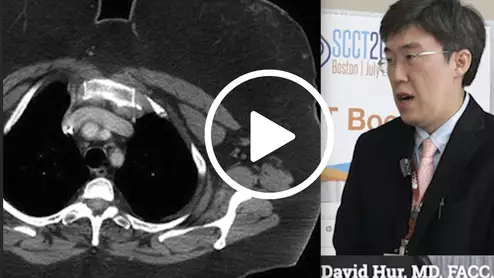 Video of David Hur discussing how to overcome technical challenges in cardiac CT, which he presented on in sessions at SCCT 2023.