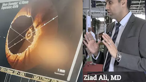 Ziad Ali, MD, explains the ILUMIEN IV trial results for OCT Vs. Angiography.