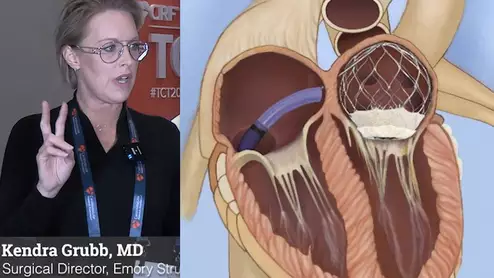 Video of Kendra Grubb discussing transcatheter tricuspid and mitral advancements at TCT 2023.