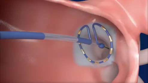 Medtronic's PulseSelect Pulsed Field Ablation (PFA) System