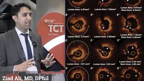 Ziad Ali, MD, explaines the impact of coronary intravascular lithotripsy (IVL) use in nodular and eccentric calcium morphologies at TCT 2023. IVL was found to produce better outcomes than atherectomy or high pressure balloons. #TCT #TCT2023 #TCT23 #IVL 