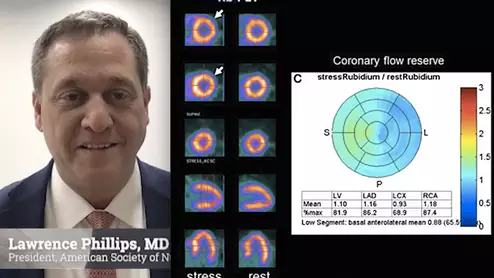 Video interview with ASNC President Lawrence Phillips, MD, NYU, who is encouraging the modernization of nuclear cardiology labs and expansion into new diagnostic areas.