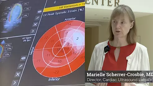 Marielle Scherrer-Crosbie, MD, Hospital of the University of Pennsylvania, discusses the latest trends in cardiac strain echo.