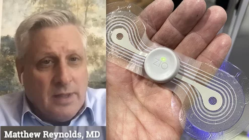 Video interview with Matthew Reynolds, MD, who shares data on largest wearable ambulatory cardiac monitoring studies to date from the EXCALIBER and CAMELOT trials at HRS 2024. #HRS #HRS2024 #Remotemonitoring