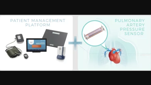 Endotronix, an Illinois-based healthcare technology company, has gained U.S. Food and Drug Administration approval for its Cordella Pulmonary Artery (PA) Sensor System, which uses PA pressure-guided therapy to manage and treat heart failure patients. 