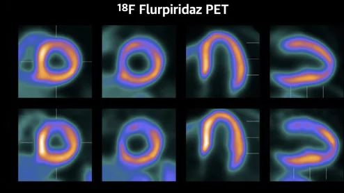 The new cardiac PET radiotracer flurpiridaz F-18 is posed to be a major game changer and will likely lead to increased adoption of cardiac PET.