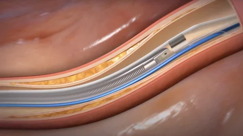 Conavi Medical’s Novasight Hybrid System catheter