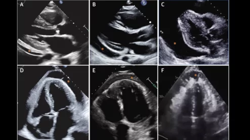 pericarditis cardiac imaging
