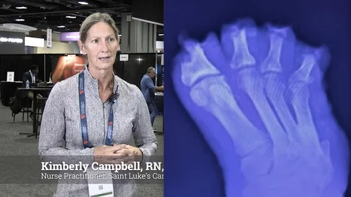 Kimberly Campbell, RN, ANP-BC, nurse practitioner, Saint Luke's Cardiovascular Consultants, explains how her health system took a heart team approach in its wound care transition program for peripheral artery disease (PAD) and critical limb ischemia (CLI) patients that lowered their amputation rate my more than 50%. 