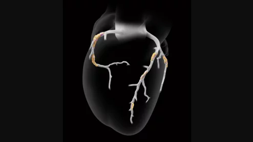 Heartflow Plaque Analysis