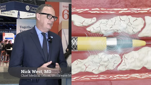 Nick West, MD, chief medical officer, Shockwave Medical, Johnson and Johnson Meditech, explains how the company is innovating intravascular lithotripsy (IVL) therapy devices and building clinical evidence from trials for its use in a variety of calcified lesions. There are several companies developing IVL therapy, but West says Shockwave will remain the market leader because of its nearly decade long head start in the market, strong clinical evidence and has about a 10% market penetration. #IVKL