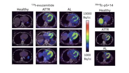PET-CT imaging of 124-I evuzamitide and SPECT-CT imaging of 99mTc-p5+14 showed radiotracer uptake in both AL and ATTR amyloid throughout the myocardium. Emily B. Martin, Anne Kassira, Alan Stuckey, et al. A tale of two tracers - Amyloid imaging with investigational radiotracers iodine (124I) evuzamitide and 99mTc-p5+14 (AT-05). https://www.journalofnuclearcardiology.org/article/S1071-3581(25)00325-3/abstract.