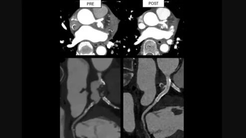 intrasaccular flow disruptor coronary aneurysm 